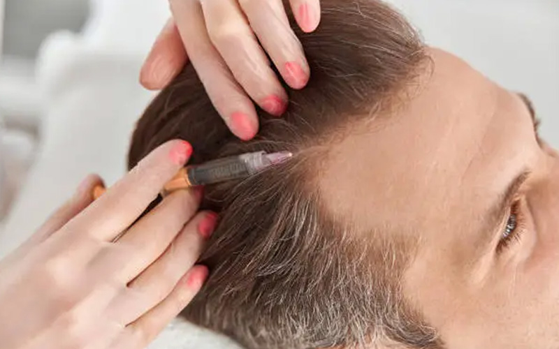 مزوتراپی مو